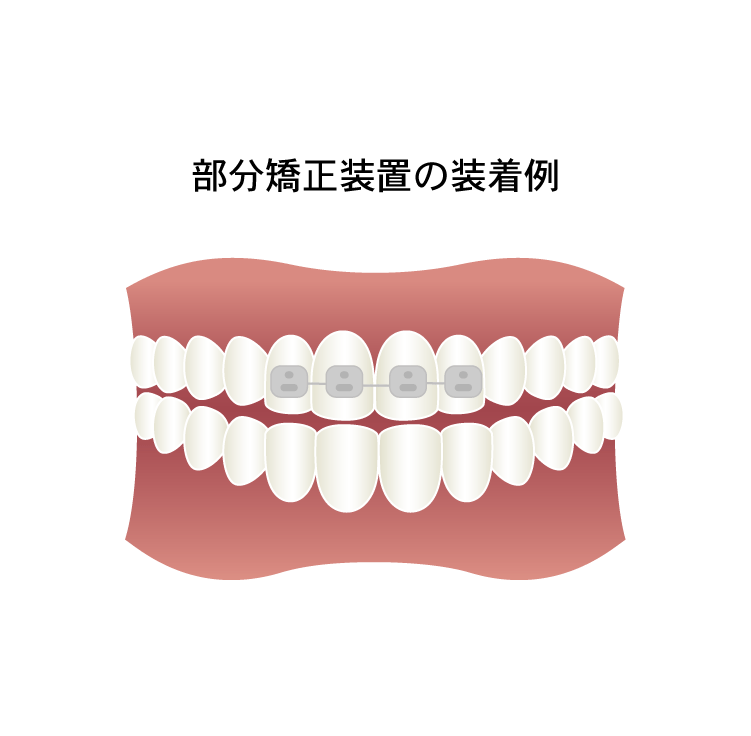 ワイヤーによる部分矯正 その他 矯正装置との比較 名駅ma矯正歯科 マウスピース型装置インビザライン矯正専門歯科