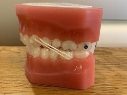 顎間ゴムをはめた顎模型