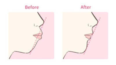 口を閉じている横顔の比較図