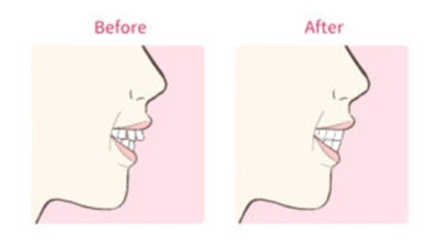 笑顔の横顔の比較図